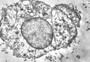 F, 62y. | myxoma atrii